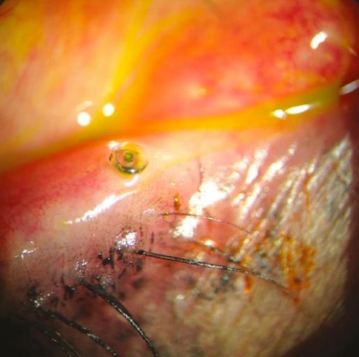 Plug Lacrimal aplicado. cob oftalmologia