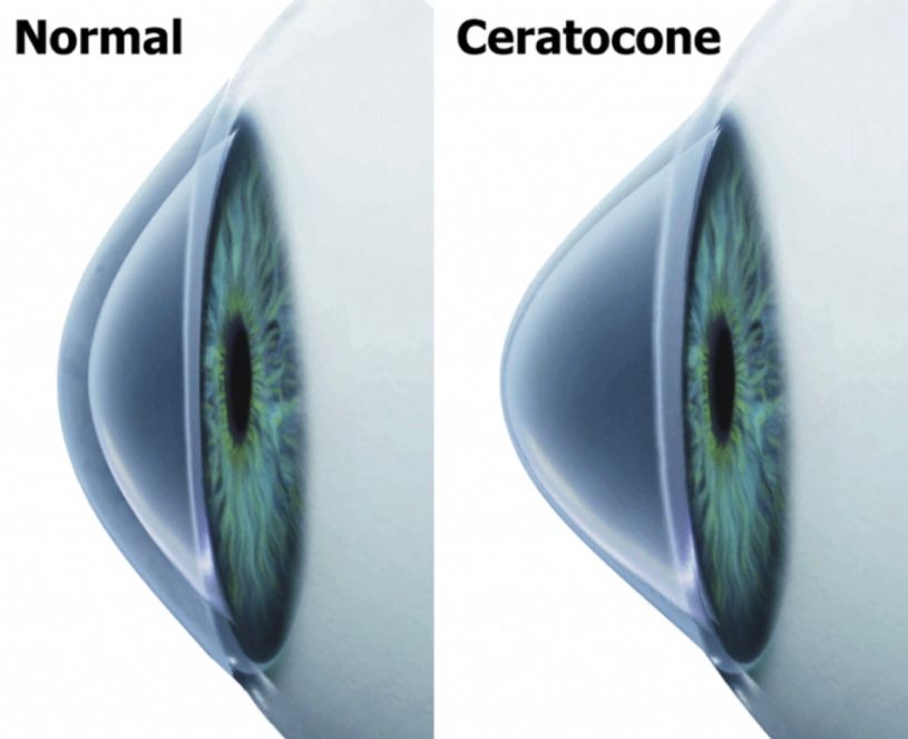 olho normal e olho com ceratocone cob oftalmologia