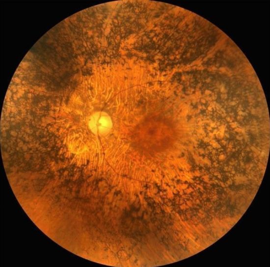 cegueira noturna comprometimento da percepcao de cores